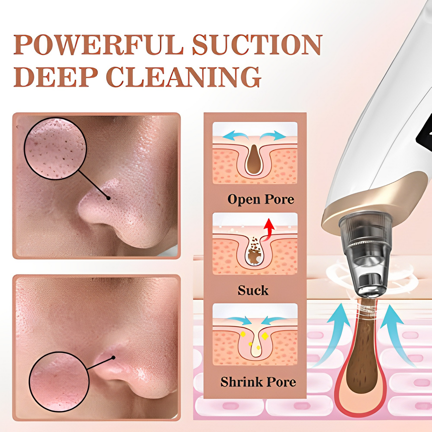 Electric Blackhead & Acne Remover: Advanced Technology for Clearer Complexions